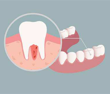 牙齿干细胞在牙周炎治疗中的应用
