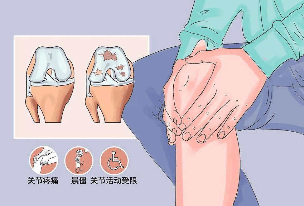 间充质干细胞治疗膝骨关节炎临床研究进展