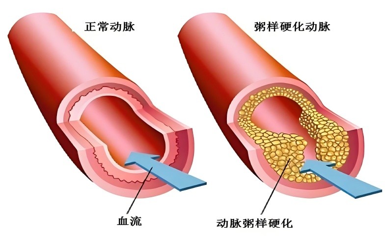 干细胞治疗动脉粥样硬化临床研究进展